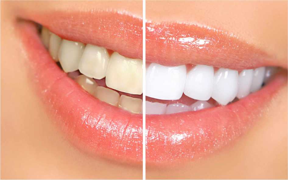 Teeth. whitening comparison image
