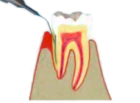Gum Disease