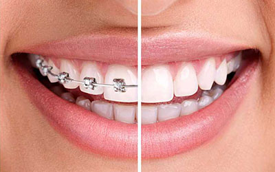 braces invisalign