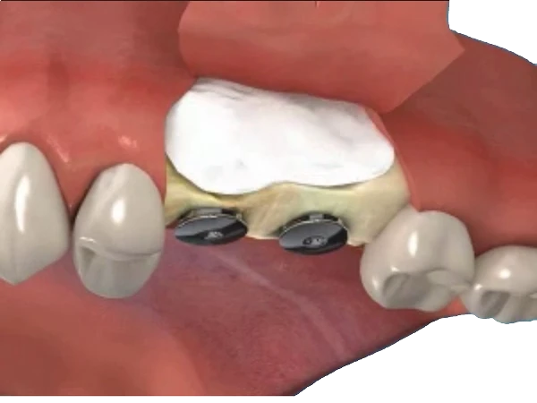 Bone implants 7