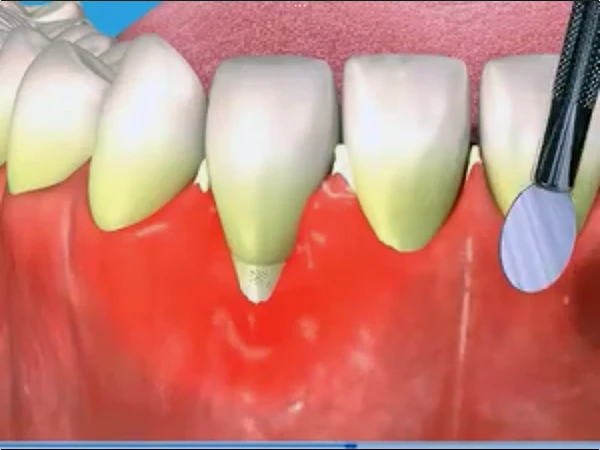 Swollen and Bleeding Gums - Dentist Johannesburg, South Africa