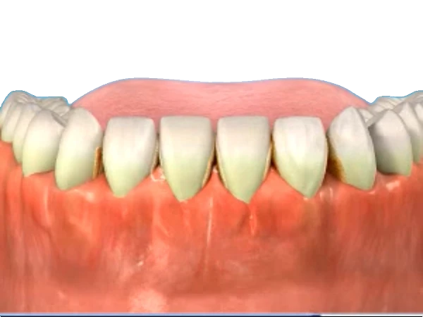 Tartar symptoms