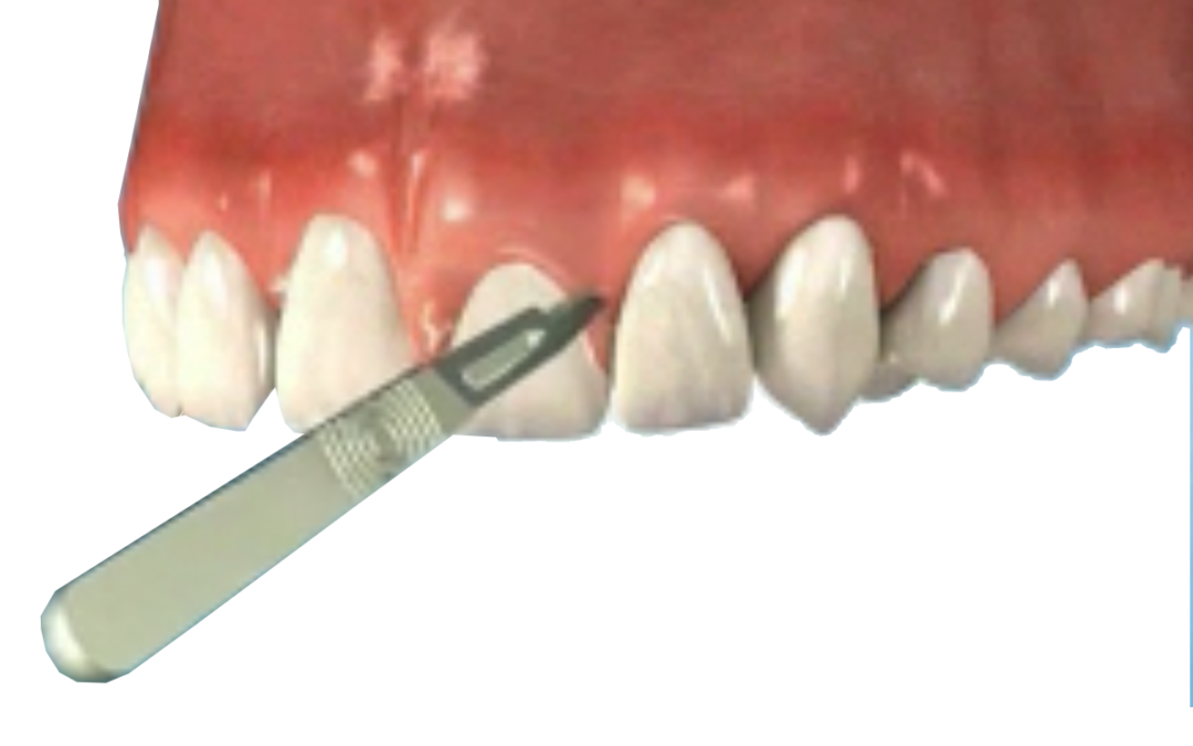 Tooth Lengthening
