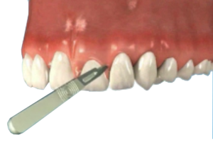 Home 20 Tooth Lenghtenting 900h
