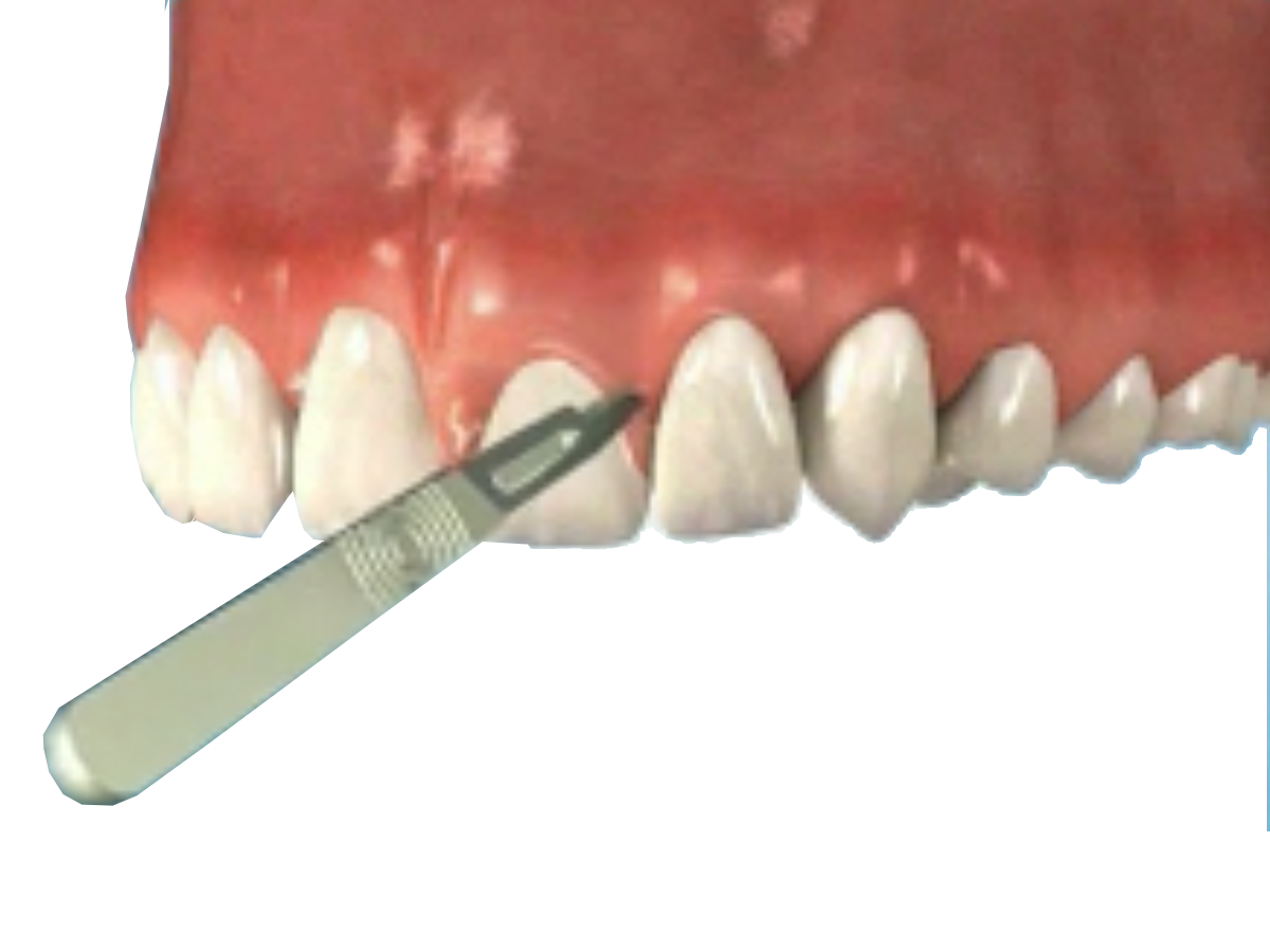 Tooth lengthening