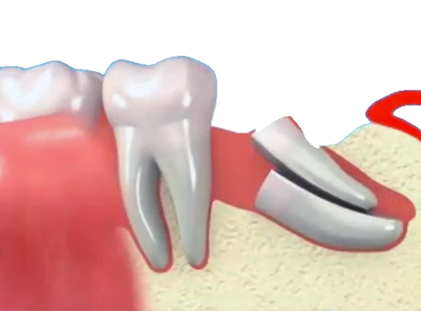 Wisdom Tooth Removal - Dentist Johannesburg, South Africa