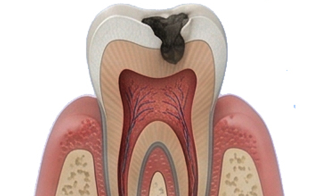 Tooth Decay