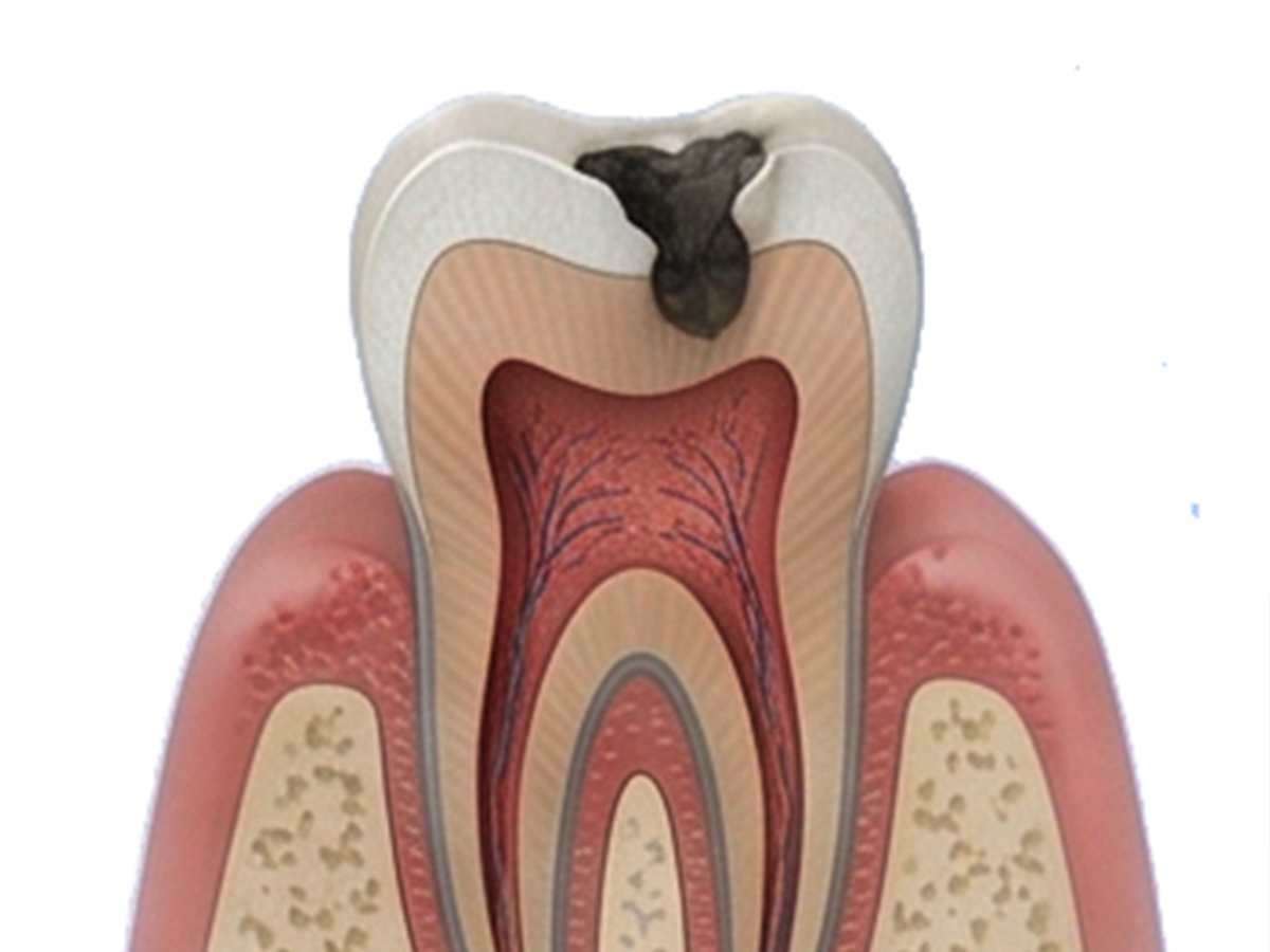 Tooth Decay & Cavity
