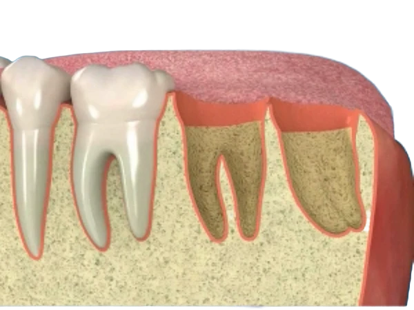 Wisdom Tooth Extraction