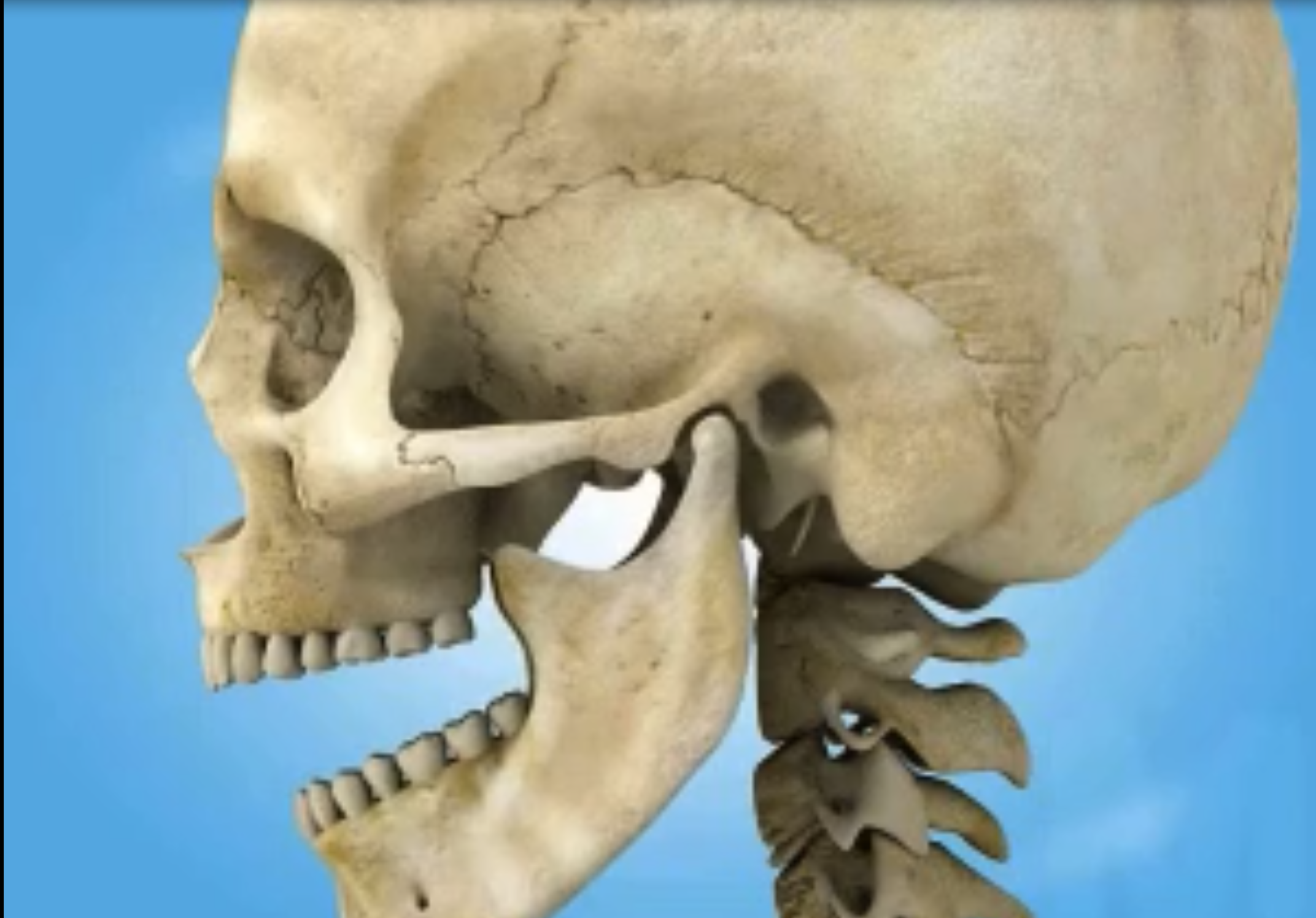 Temporomandibular joint dysfunction (TMJ)