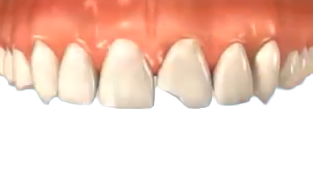 Chipped, Cracked or Broken Tooth