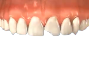 Chipped tooth treatment x