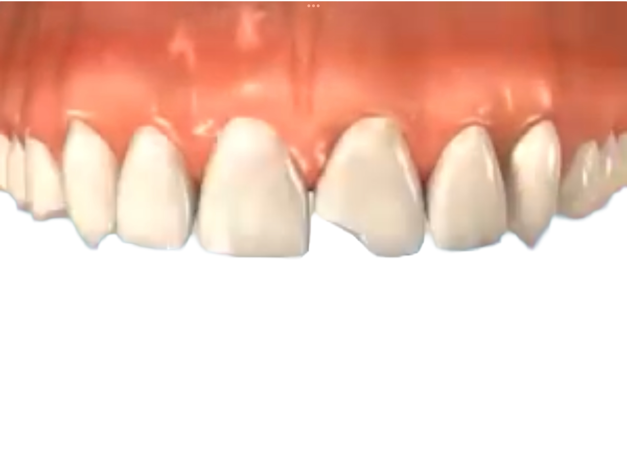 Chipped tooth treatment- Johannesburg