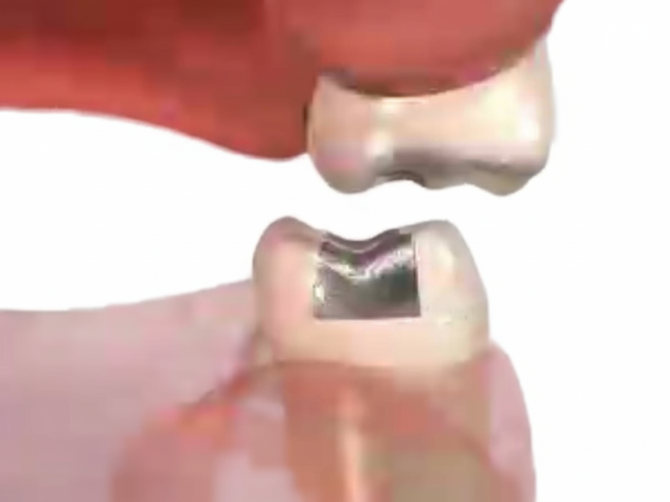 Permanent or Temporary Crown is Loose or Falls Out