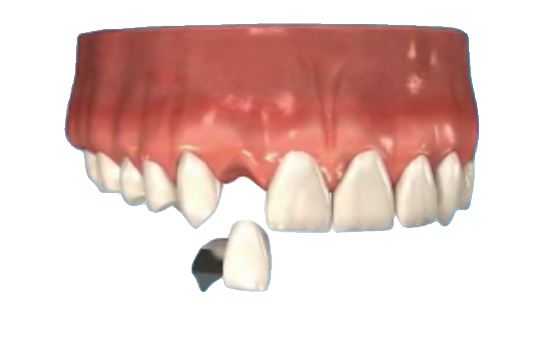 Missing-Tooth-Bridge