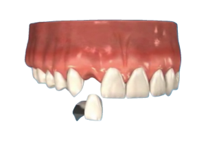 Missing Tooth Bridge x