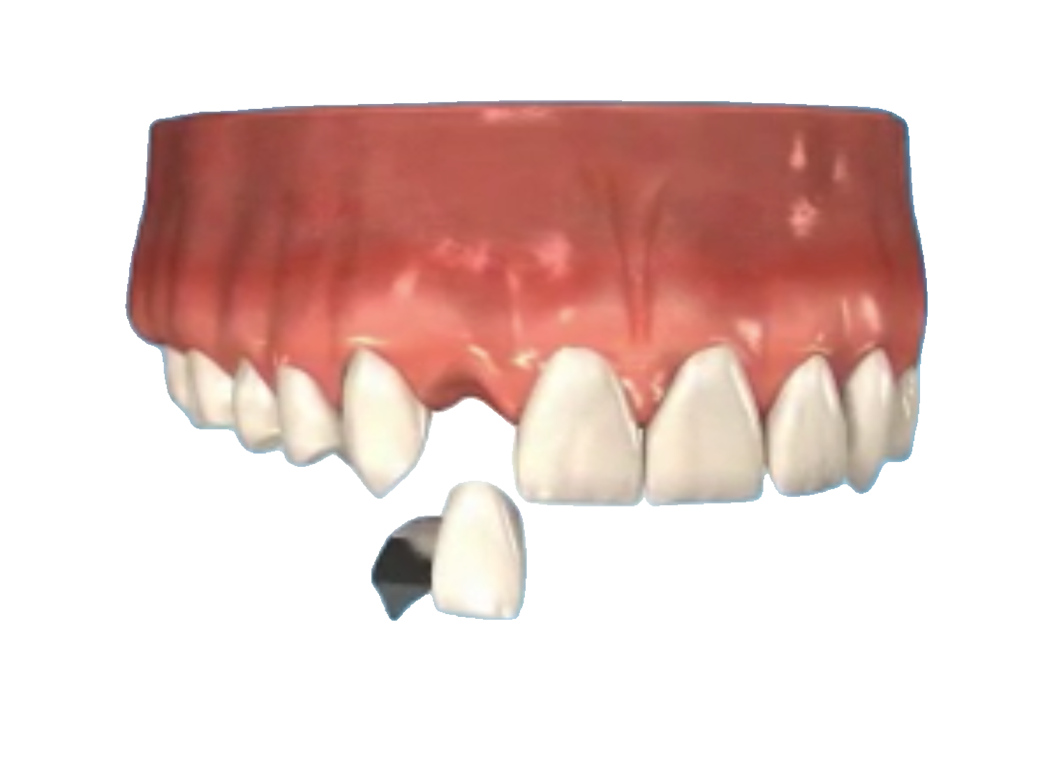 Missing-Tooth-Bridge