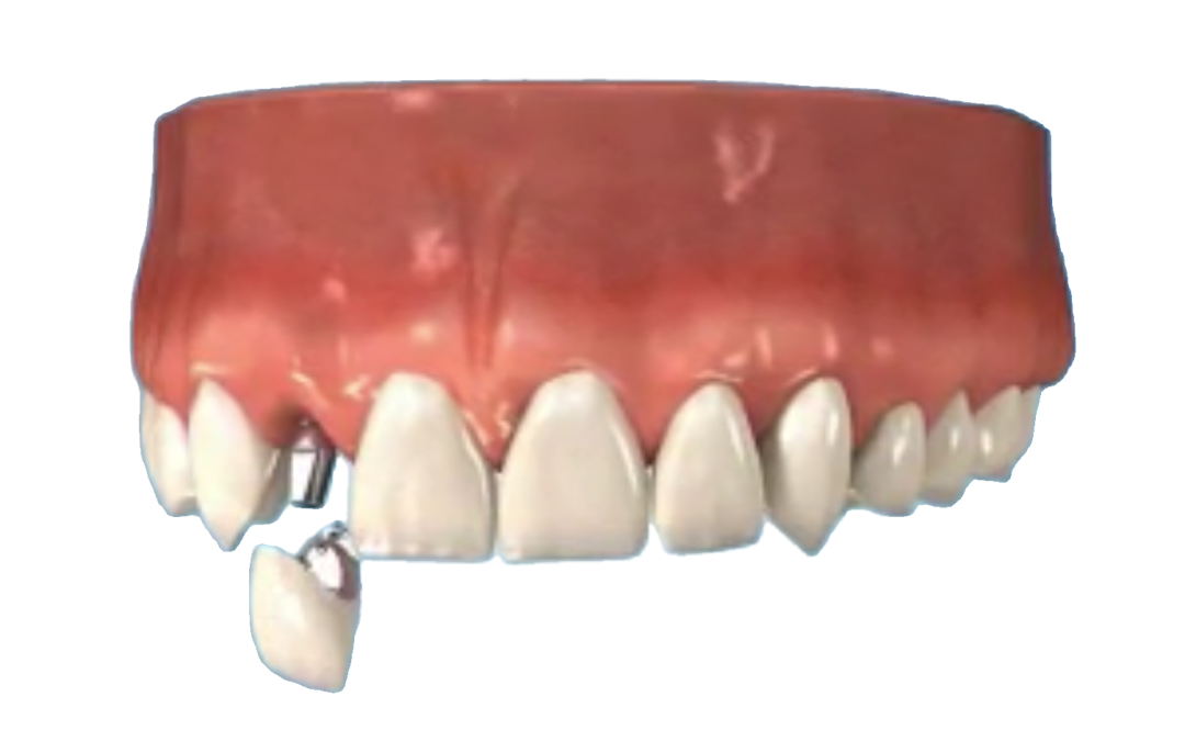 Single Dental Implants