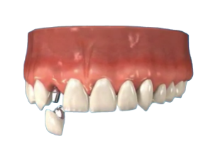 Missing Tooth Implant x