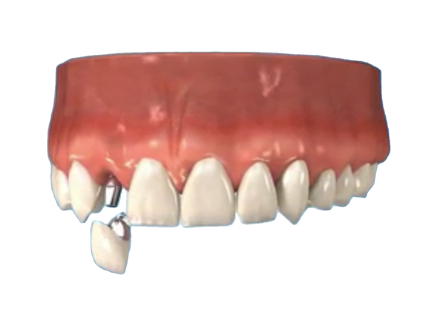 Single Dental Implants - Dentist Johannesburg, South Africa