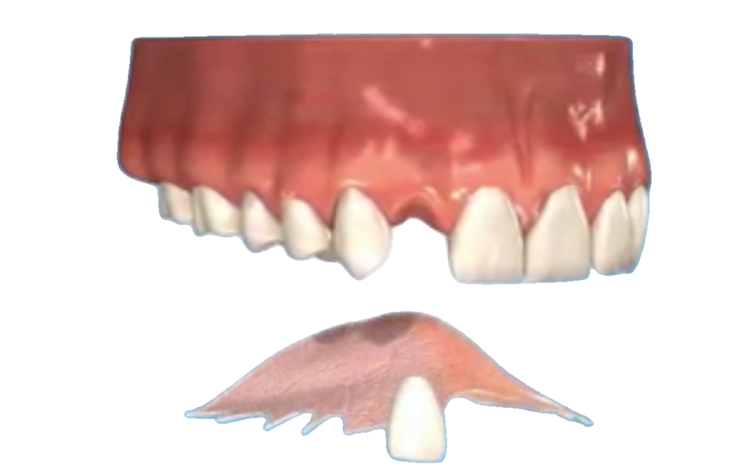 Dentures