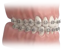 orthodontic braces with metal wires