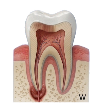 Root Canal