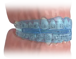 myobrace and braces, combined treatment