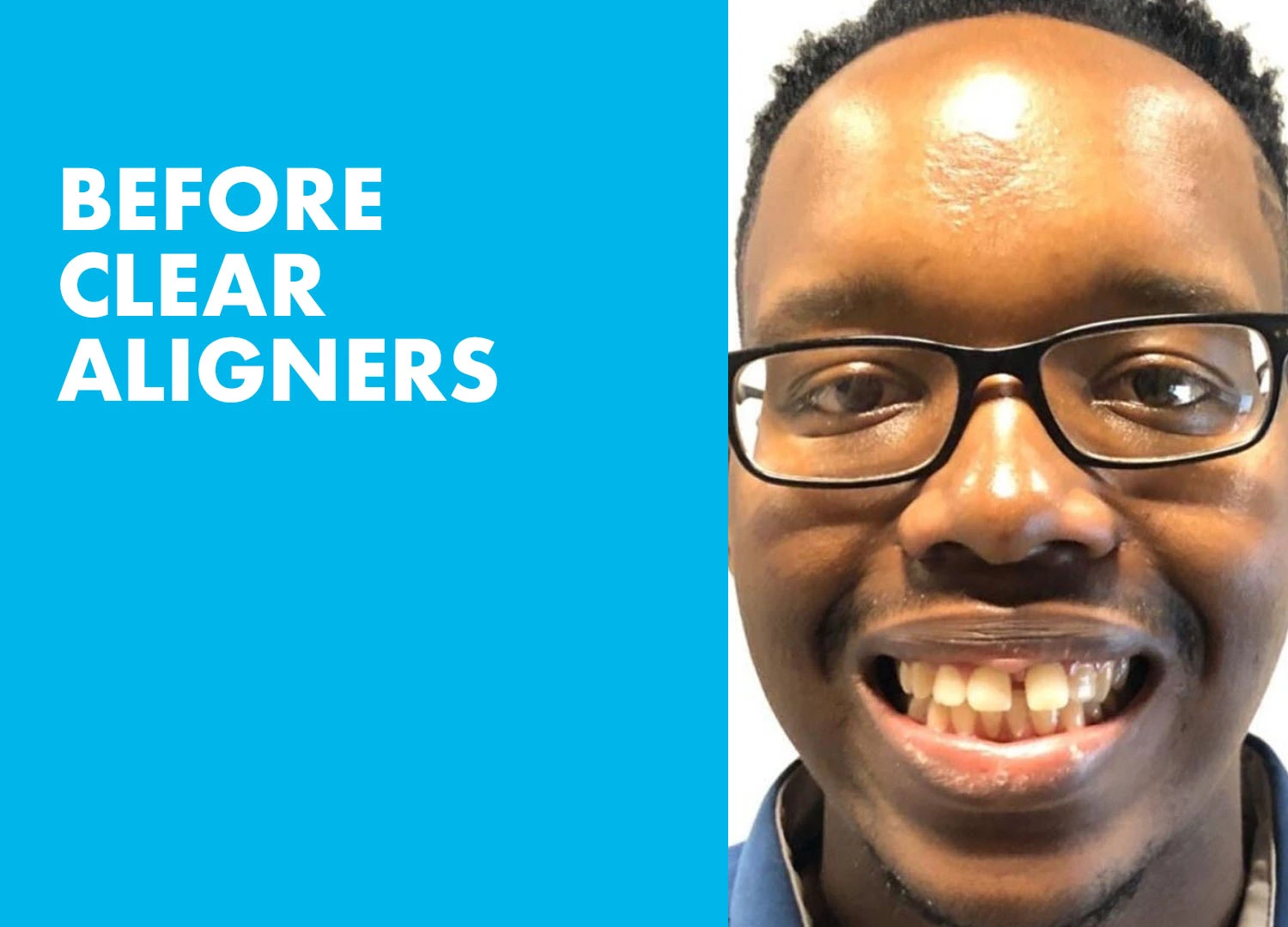 ACTIVE ALIGNERS Before and After 1