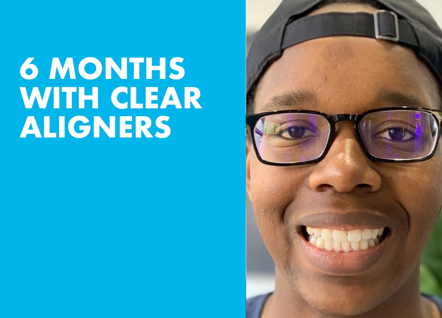 ACTIVE ALIGNERS Before and After 2