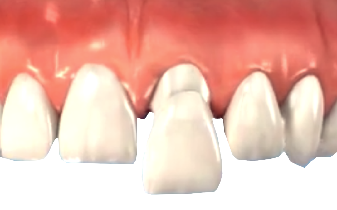 Porcelain Crowns