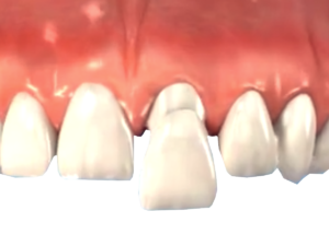Anterior Crown 900h