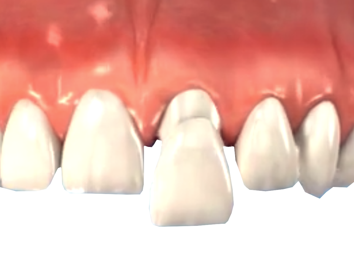 Front tooth crown (anterior incisor crown) 3d illustration