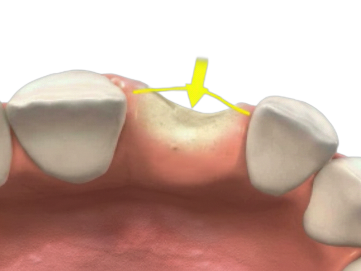 Bone Loss Front Teeth