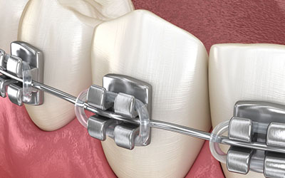orthodontic-braces